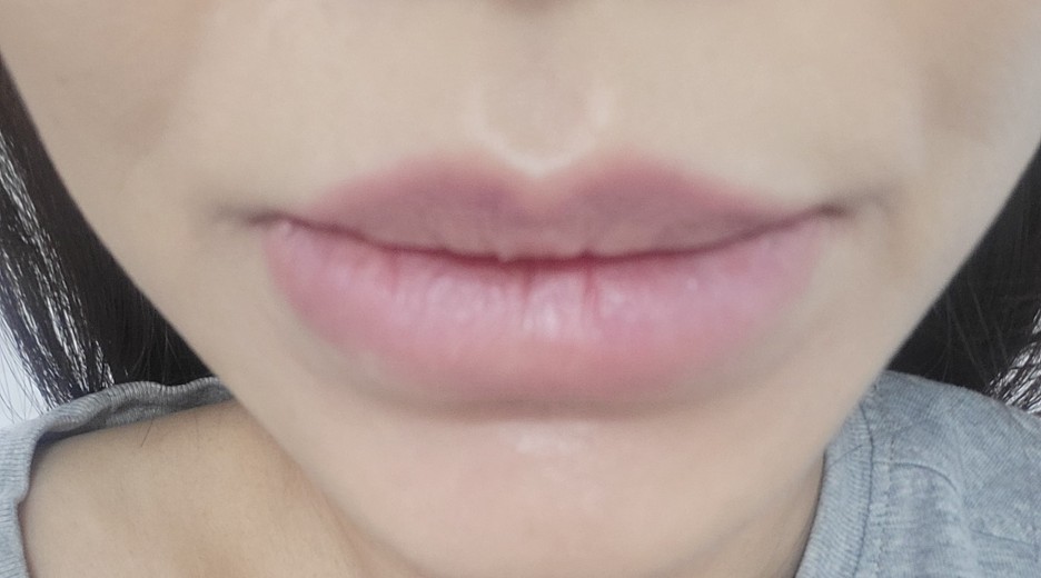 after photo: 입술축소술