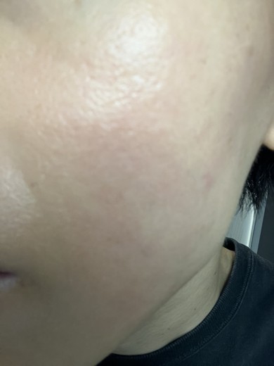 before photo: イオン導入