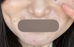 再来OK】ハイドラフェイシャル＋エレクトロポレーション | おおかみ