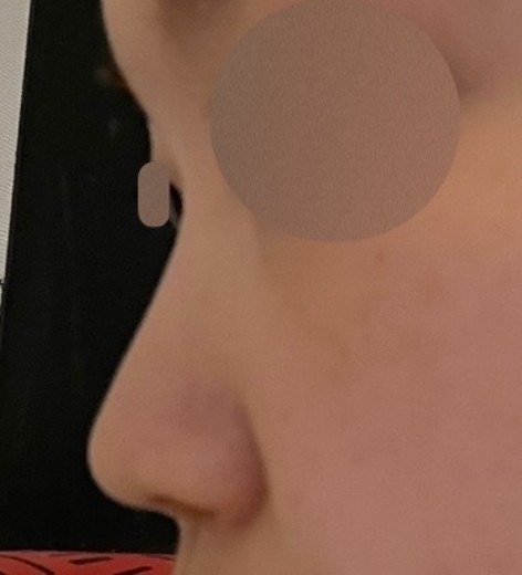 before photo: 비중격만곡증수술, 콧대(보형물), 코끝(자가연골)