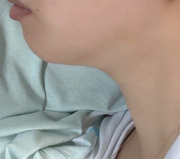 after photo: 脂肪溶解注射(顔)