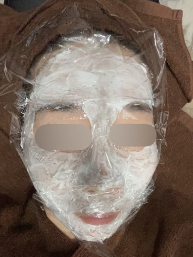 after photo: ダーマペン
