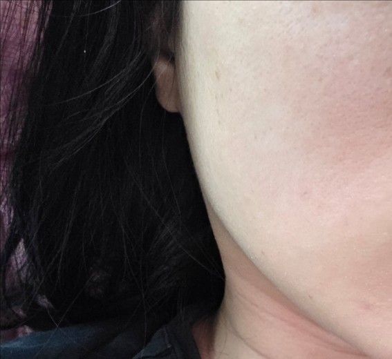 after photo: 온다리프팅