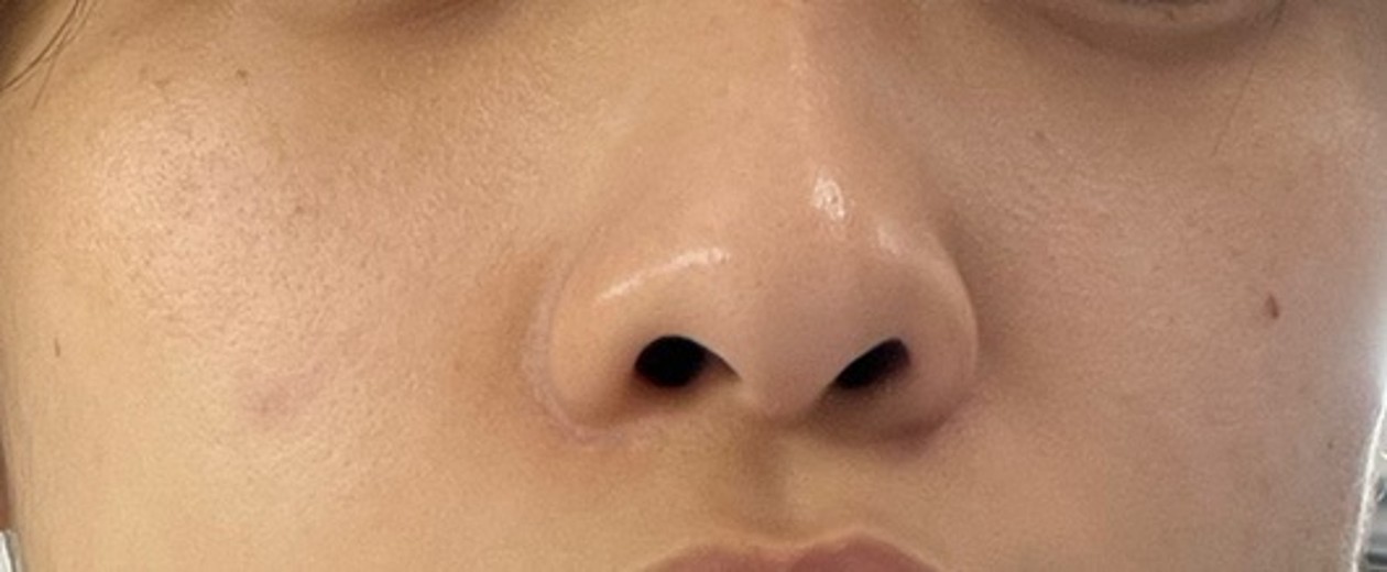 after photo: 피코토닝