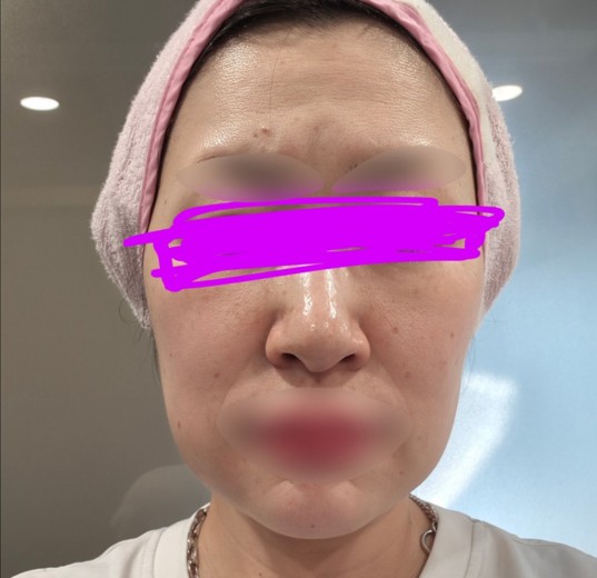 before photo: ピコトーニング
