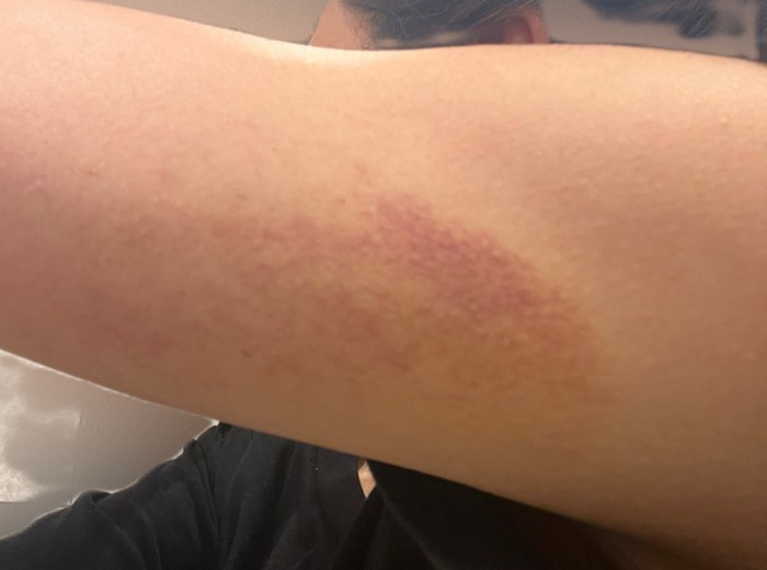 after photo: 脂肪冷却(腕), 脂肪冷却(太もも)