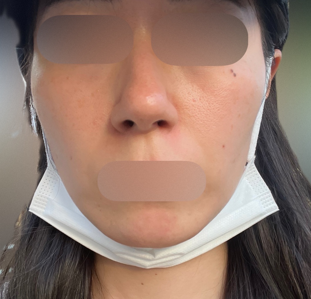 ピーリング　エレクトロポレーション エレクトロポレーション＋ピーリング | フォンタナクリニック天神