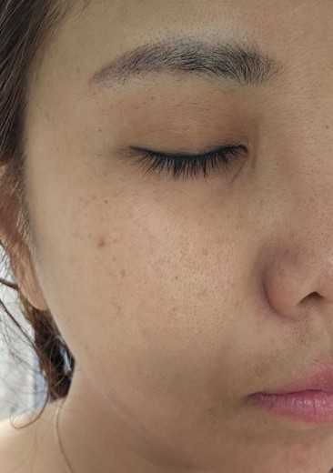 before photo: 점제거시술, V레이저