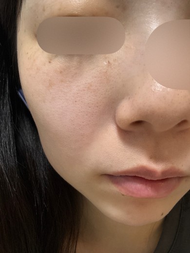 after photo: ハイドラフェイシャル