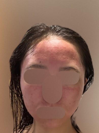 after photo: ダーマペン