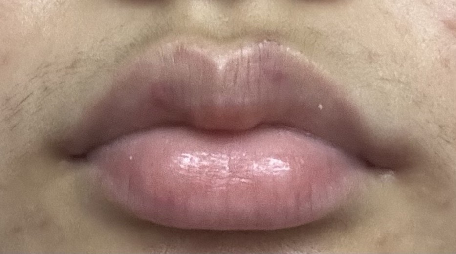 after photo: 입꼬리필러, 입술필러