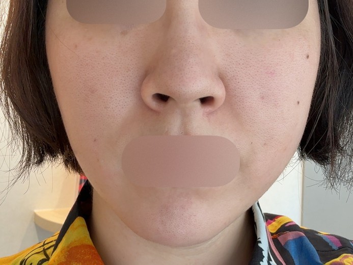 after photo: 糸リフト