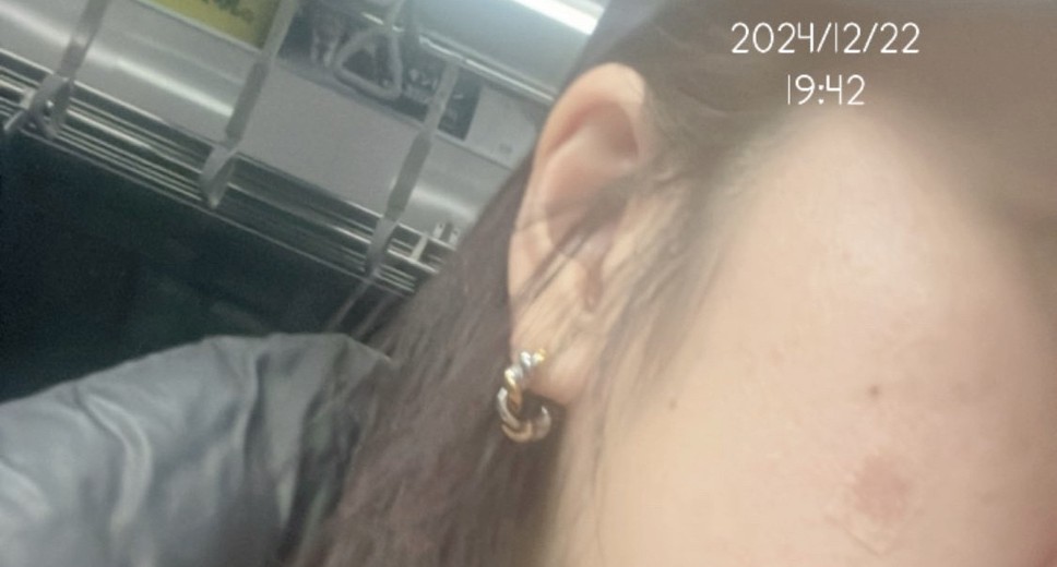 after photo: Qスイッチレーザー