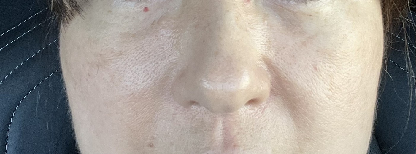 before photo: 脂肪溶解注射(顔)