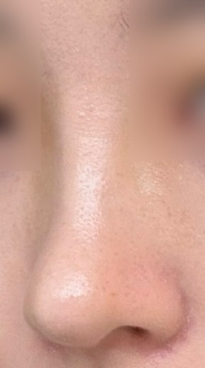 after photo: 콧대(보형물), 코끝(자가연골)