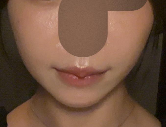 after photo: サーモン注射
