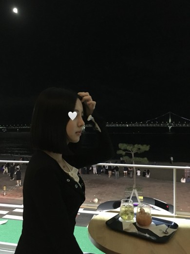 after photo: 콧대(보형물), 코끝(자가연골)