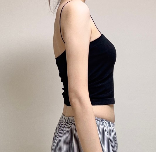 after photo: 팔지방흡입, 부유방흡입