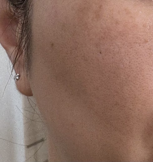 before photo: ピコトーニング