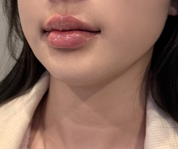 after photo: 입술필러