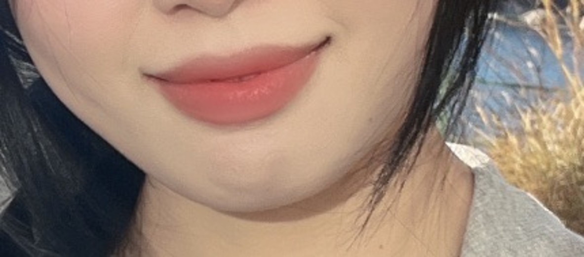 after photo: 입꼬리필러, 입술필러