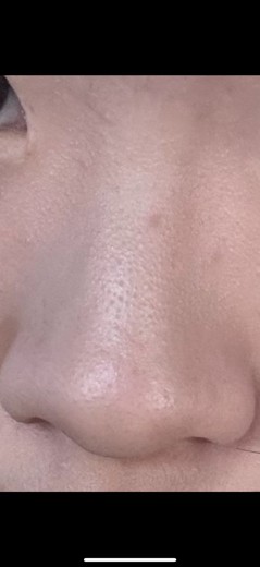 after photo: 콧볼보톡스, 코조각주사