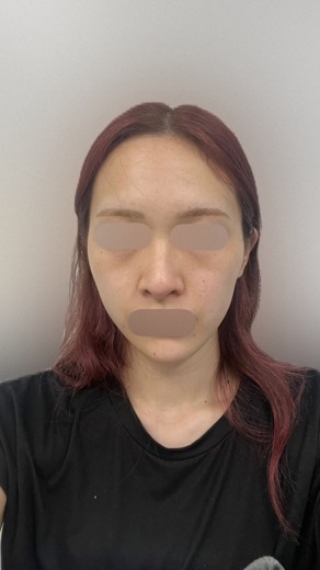 before photo: 目の下ヒアルロン酸