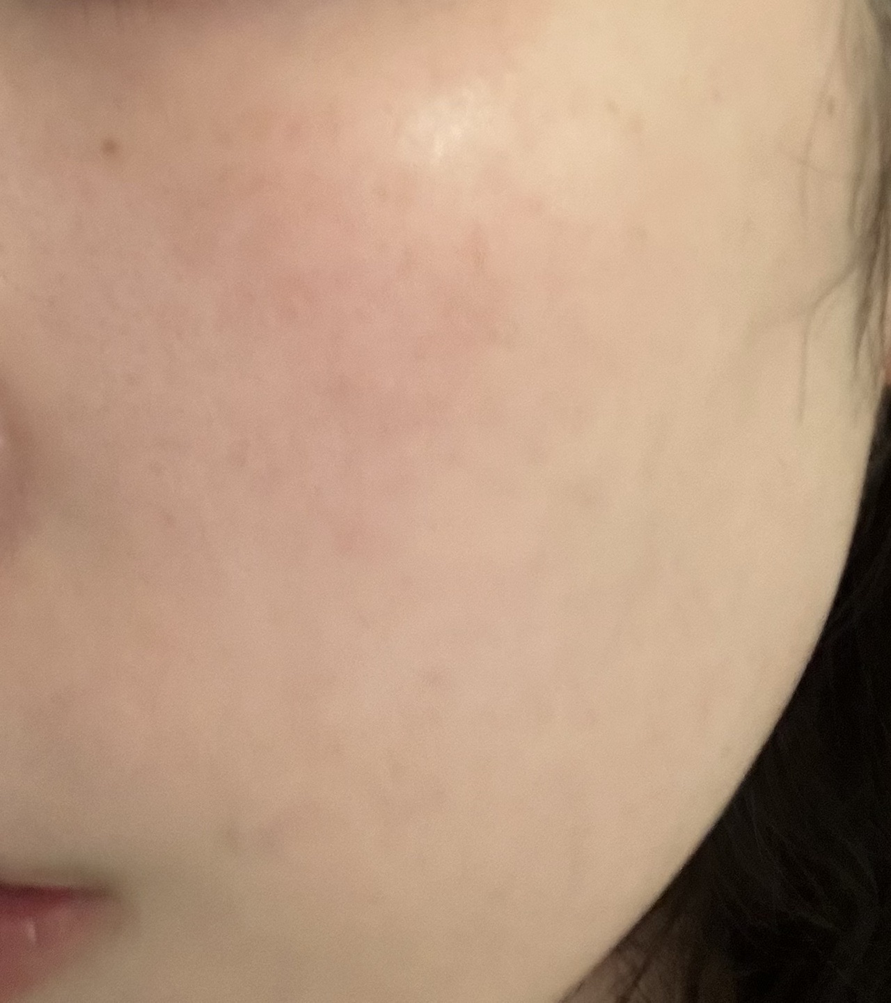 初診限定】ララピール（全顔）＋エレクトロポレーション | 心斎橋KT