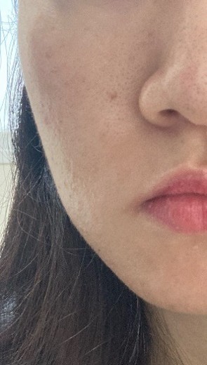 before photo: 스킨스케일링, 네오빔