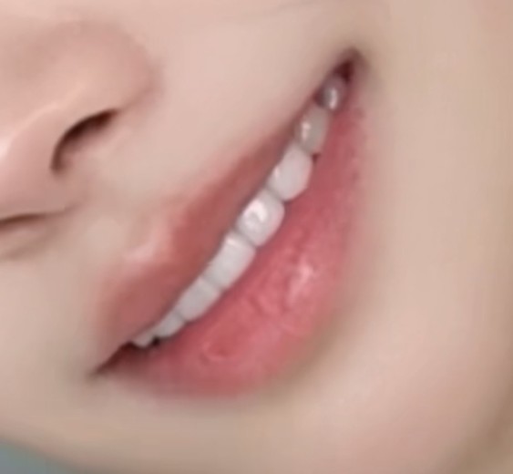 after photo: 라미네이트