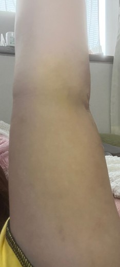 after photo: 脂肪吸引(腕)