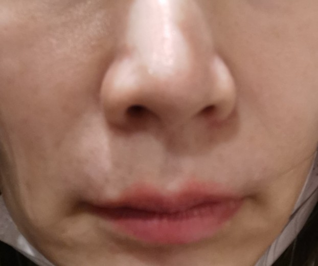 before photo: 脂肪溶解注射(顔)