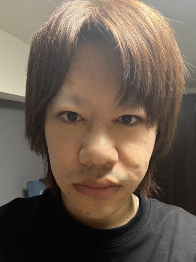 after photo: 脂肪溶解注射(顔)
