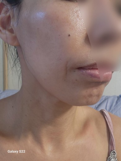 before photo: 水光注射