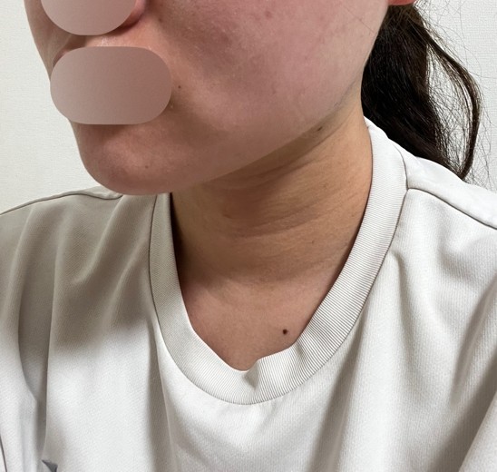after photo: 脂肪吸引注射
