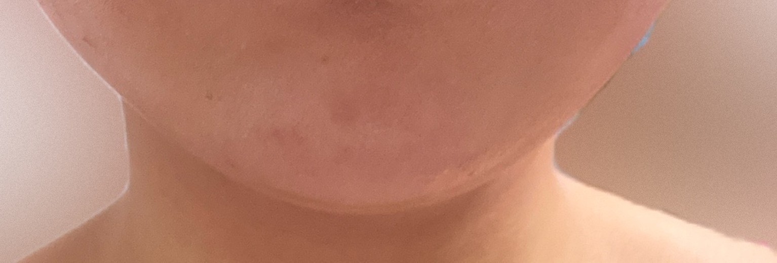 after photo: 脂肪溶解注射(顔)