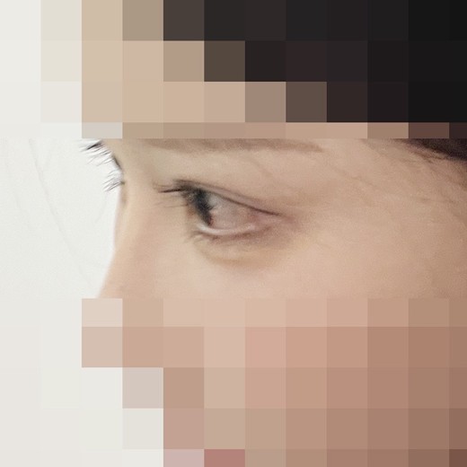 after photo: 밑트임, 뒤트임