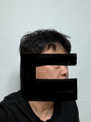 before photo: 눈밑지방재배치