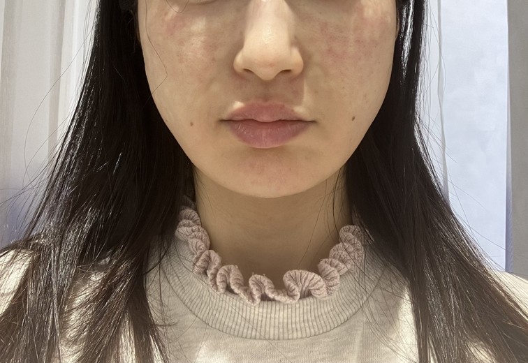 after photo: ジュベルック(Juvelook)