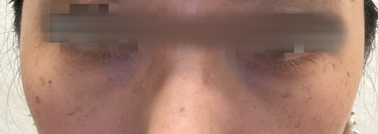 before photo: 目の下の脂肪注入(クマ治療)