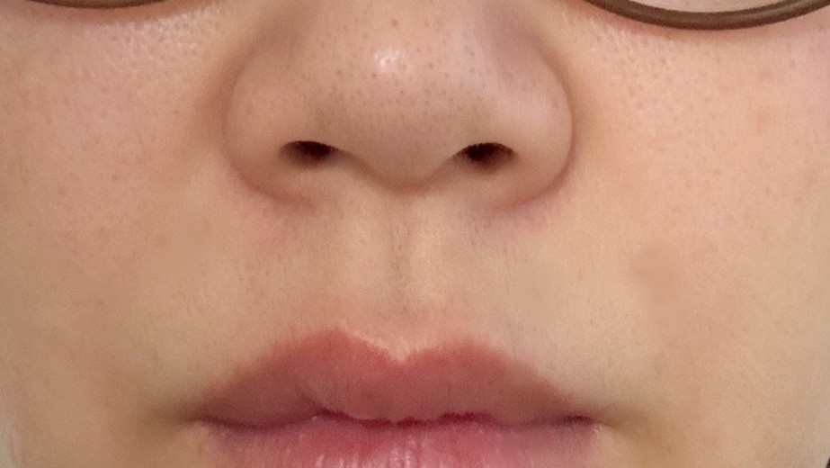 after photo: 小鼻ボトックス, 鼻先ボトックス
