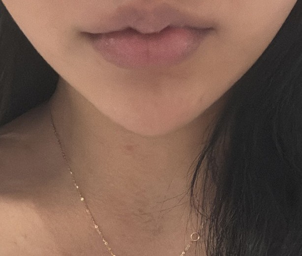 after photo: 턱필러