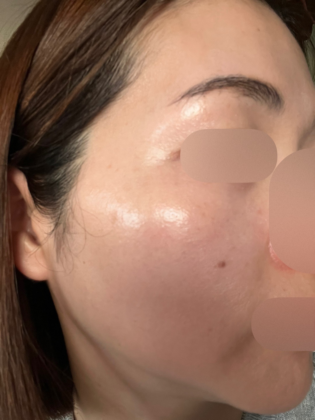 IPL（光治療）全顔2周 ｜ステラM22フォトフェイシャル【1月31日迄にご