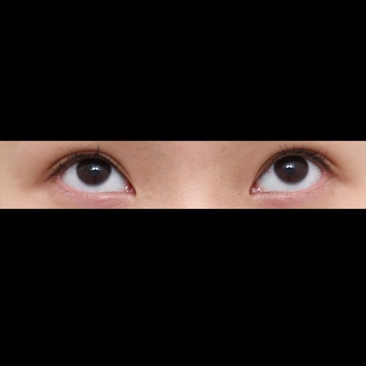 before photo: 밑트임, 뒤트임