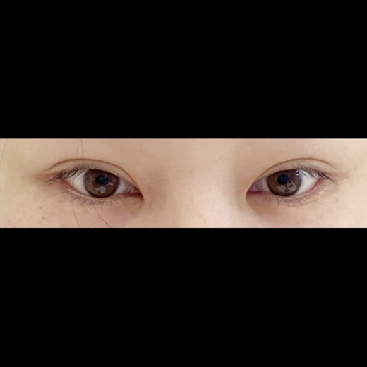 before photo: 밑트임, 뒤트임