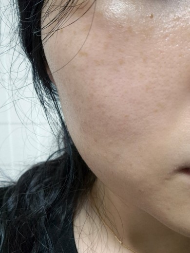 before photo: 레이저토닝