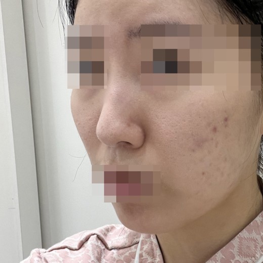 before photo: 코끝(자가연골)