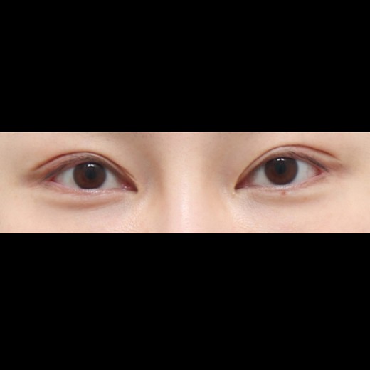 before photo: 밑트임, 뒤트임