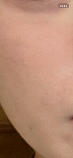 before photo: ダーマペン