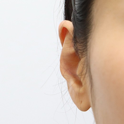 before photo: 귓볼필러